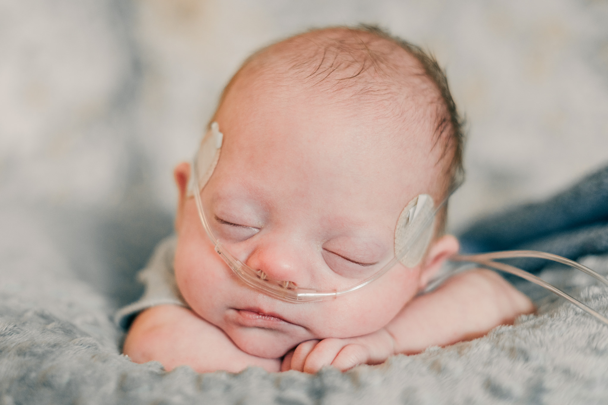 A tiny baby with Down syndrome peacefully rests with his head on his folded arms. He wears oxygen tubing and stickers on his face. Image taken by San Antonio special needs photographer Cassey Golden.